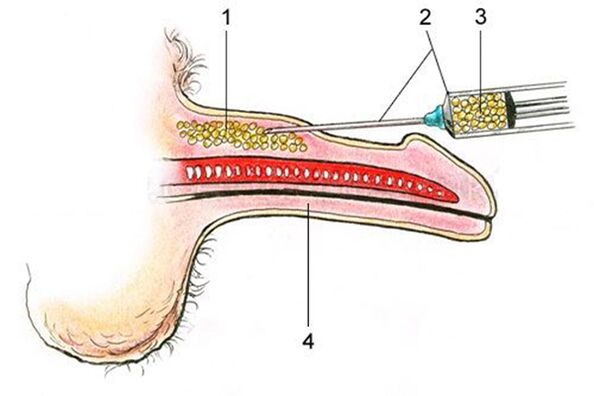 Lipofiling - unošenje masnog tkiva u tijelo penisa