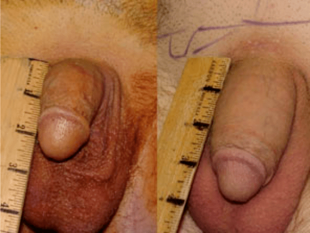 Prije i poslije lipofilinga i ugradnje gela
